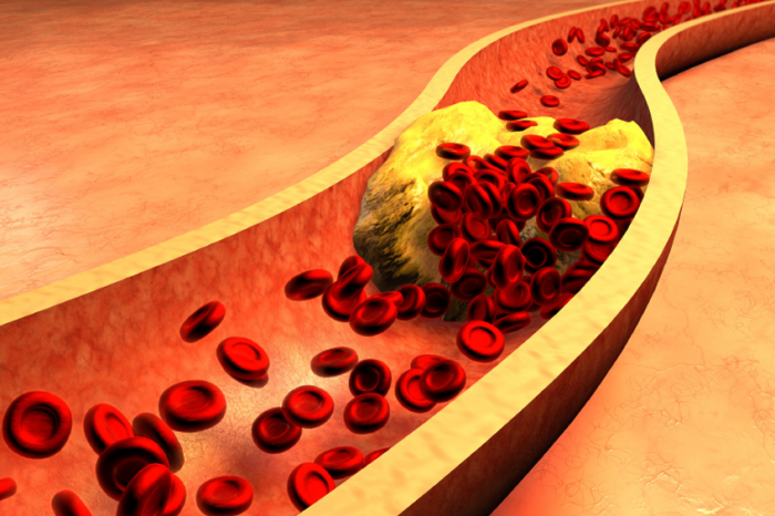 Demystifying Cholesterol