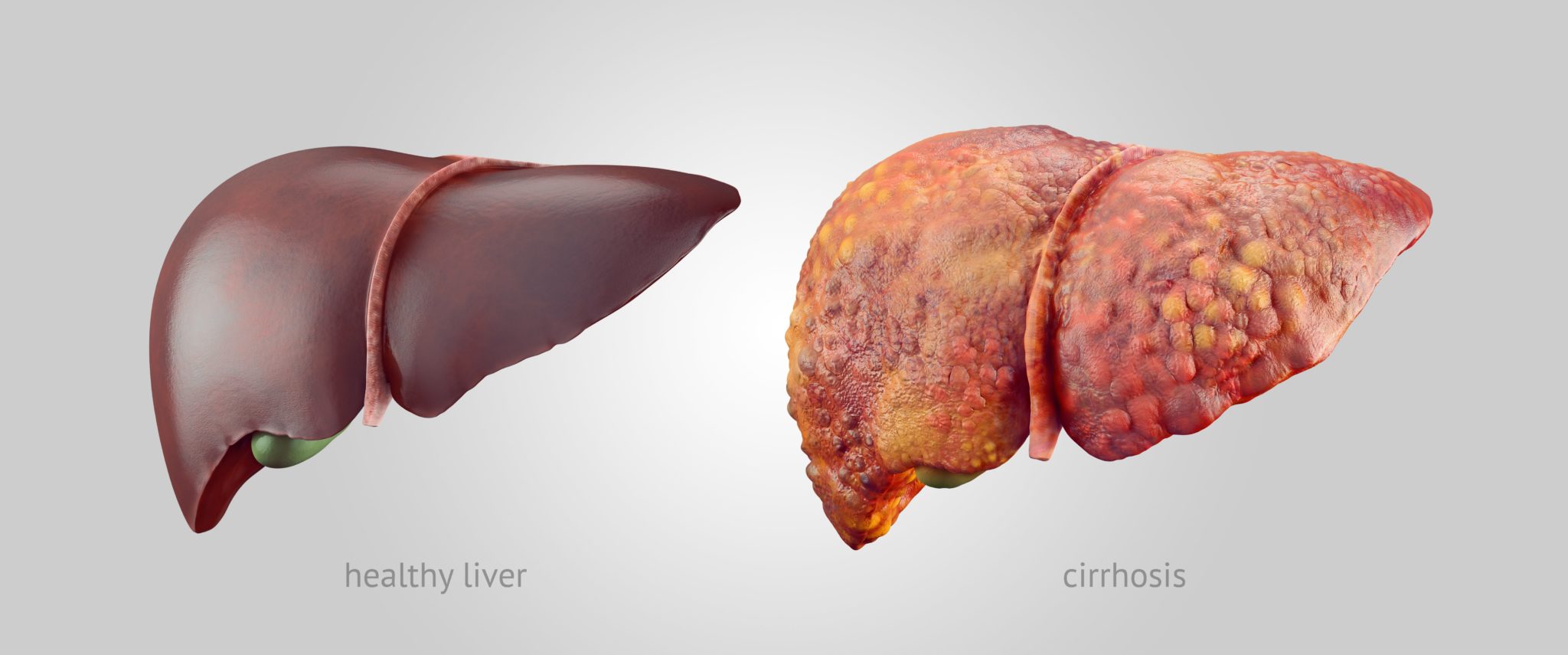 Fatty Liver 