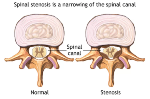 Spinal-Stenosis