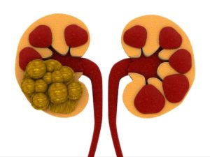 Prevent and Treat Kidney Stones Naturally