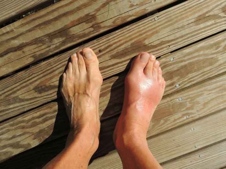 Coping with Gout