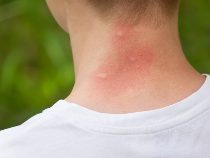 Natural Remedies for Mosquito Bites