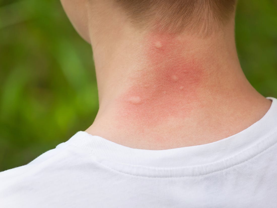 mosquito bite itch relief cvs